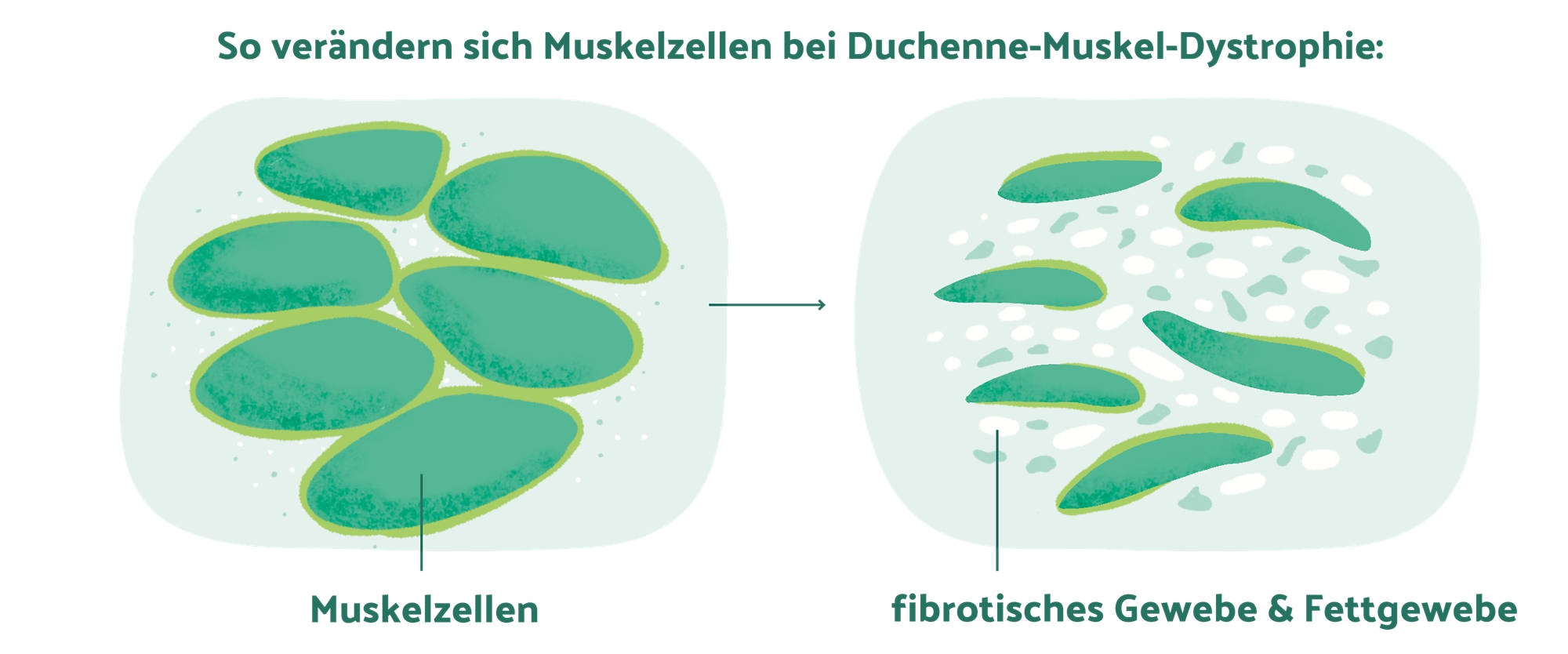 schweregrade-haemophilie.jpg