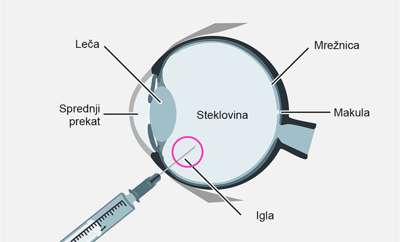 Injekcija zaviralcev VEGF v steklovino očesa za  zdravljenje diabetičnega makularnega edema.