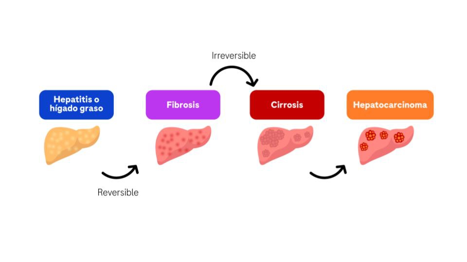 Enfermedad hepática crónica fibrosis y cirrosis