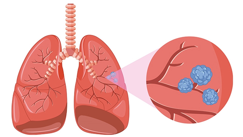 Cáncer de Pulmón Microcítico y No Microcítico