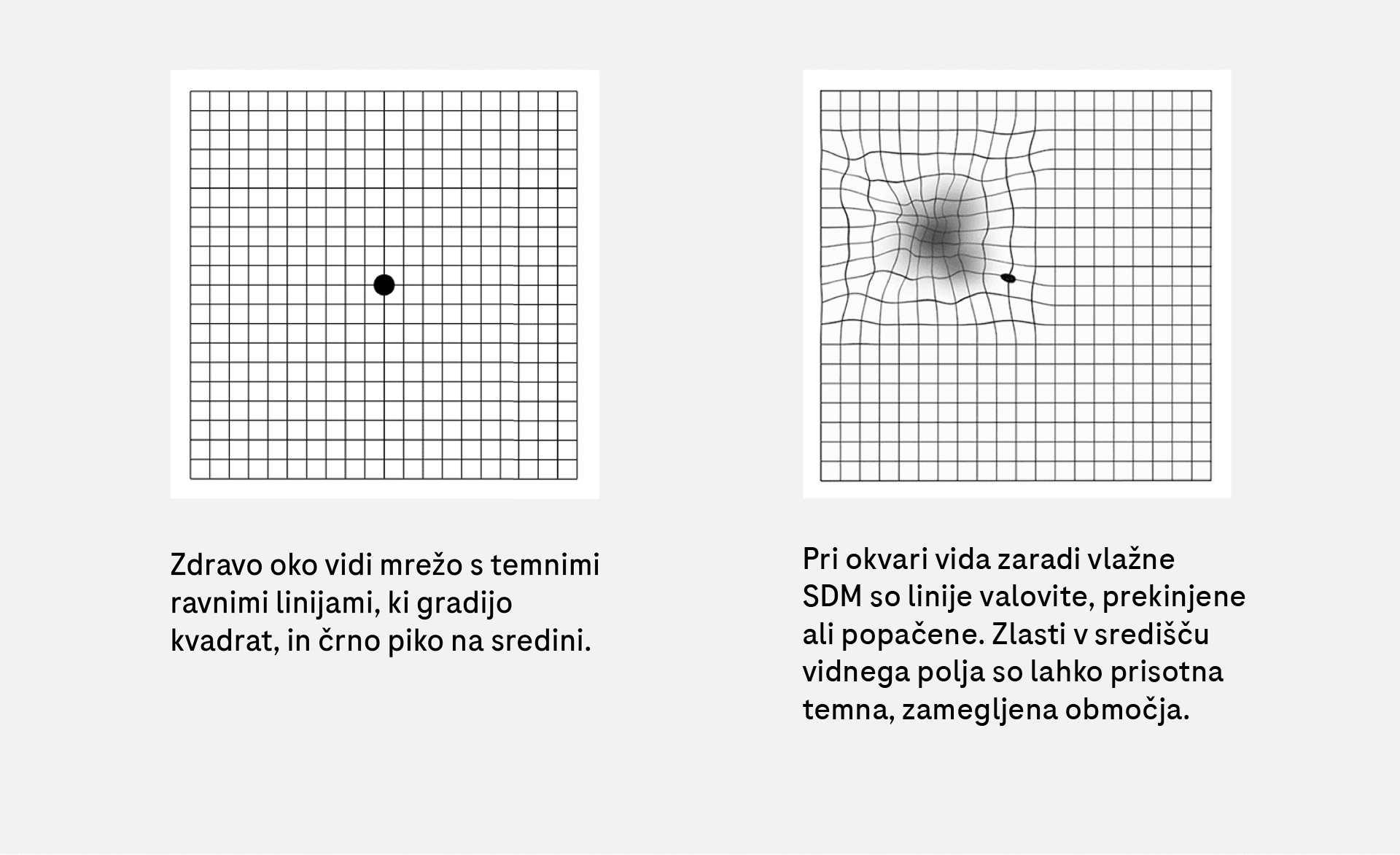 Primerjava vida zdravega očesa in očesa z vlažno obliko starostne degeneracije makule pri testu z Amslerjevo mrežo.