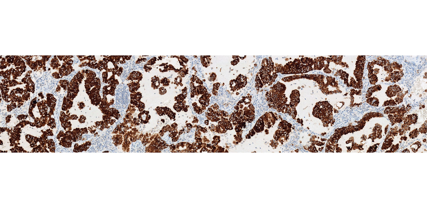 VENTANA ALK (D5F3) CDx Assay