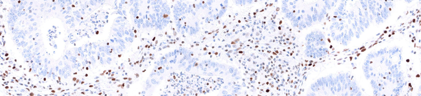 VENTANA MMR IHC stain