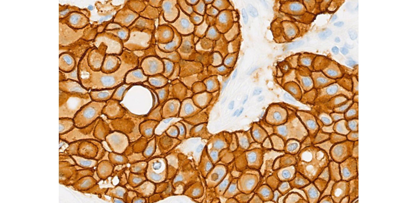 VENTANA SP263 assay therapy and slide image