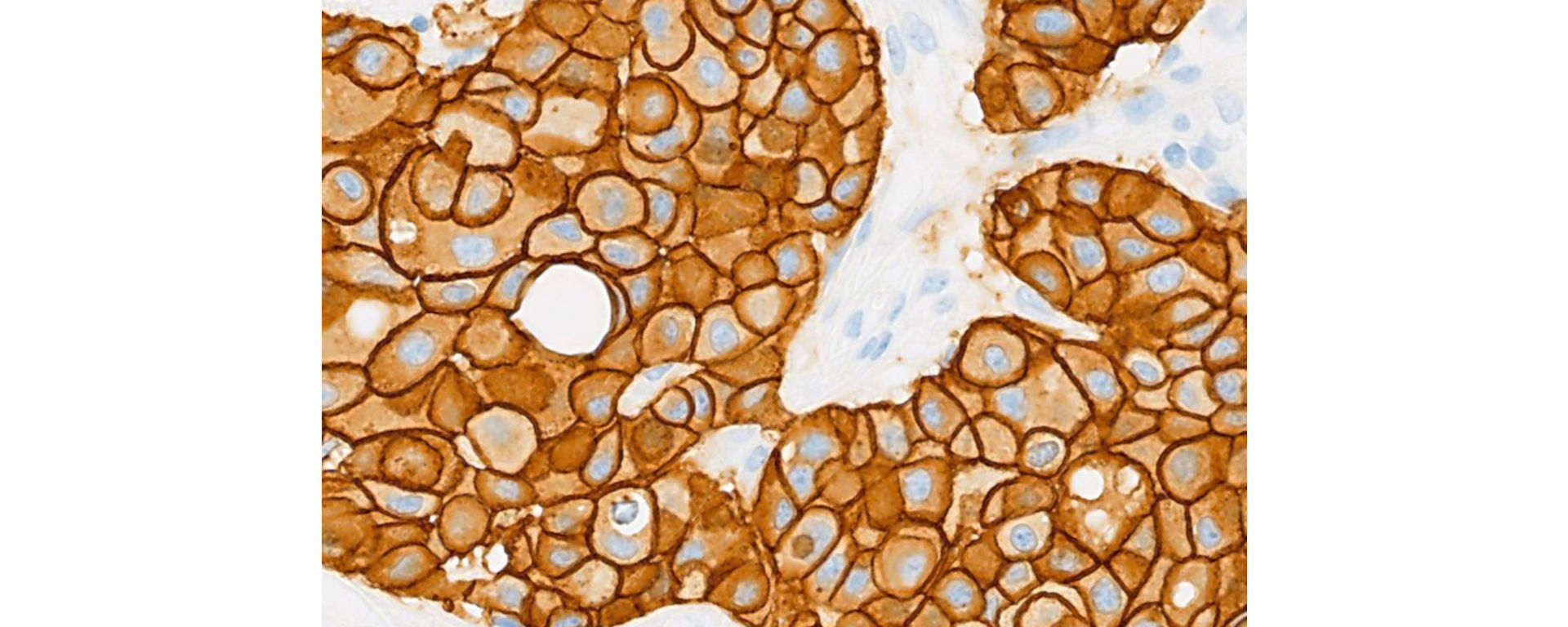 Pathway HER2 product hero image