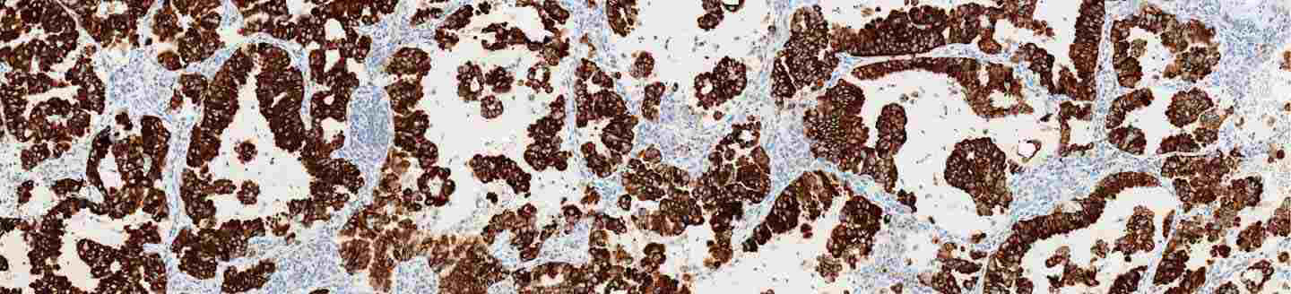 Roche VENTANA ALK (D5F3) CDx Assay stain image