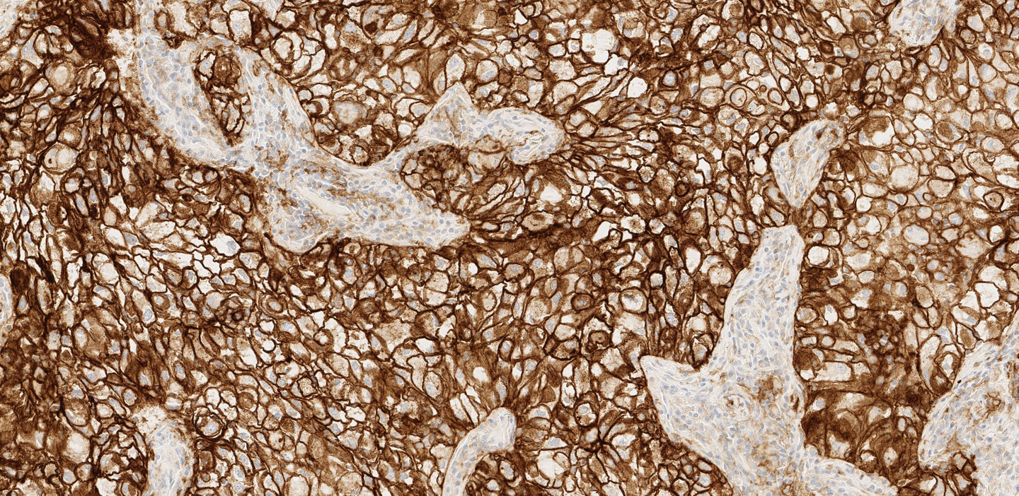 Prueba VENTANA PD-L1 (SP263), carcinoma pulmonar no microcítico (CPNM), carcinoma urotelial, cáncer de vejiga