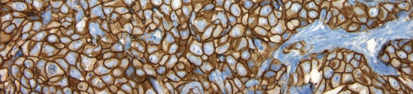 Roche VENTANA HER2 4B5 breast cancer IHC stain