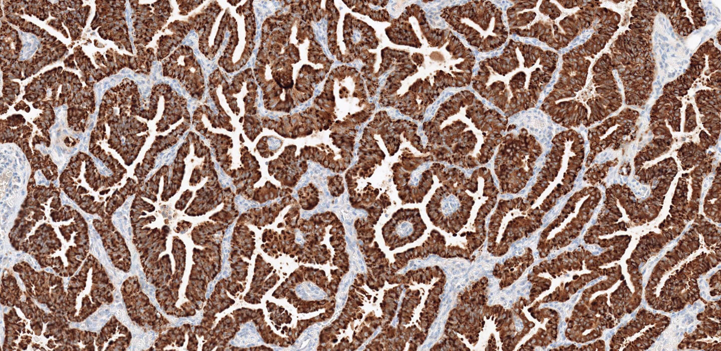 ROS1 vävnad lungcancer bild
