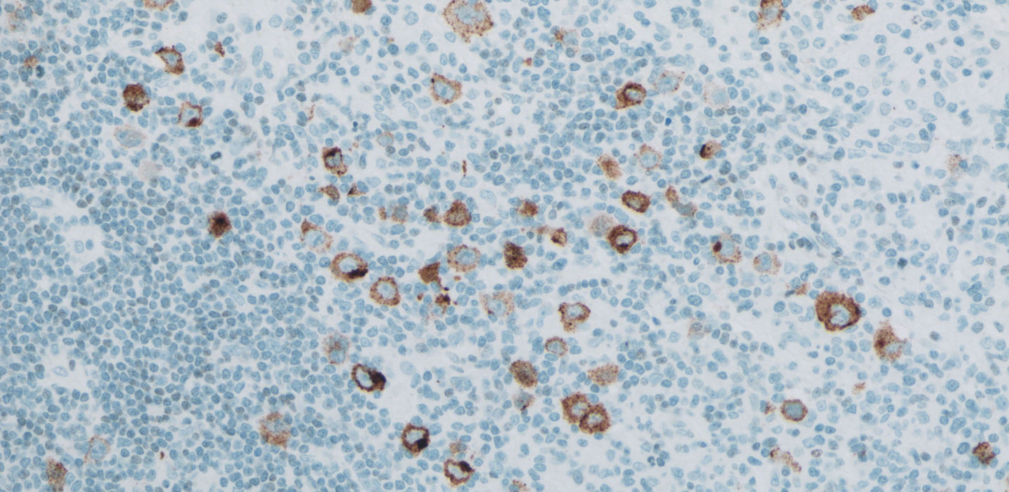 Epstein-Barr Virus (CS1-4), Hodgkin’s Lymphoma, 200x