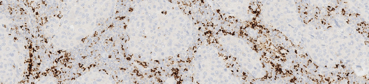 VENTANA PD-L1 SP142 IHC assay stain image