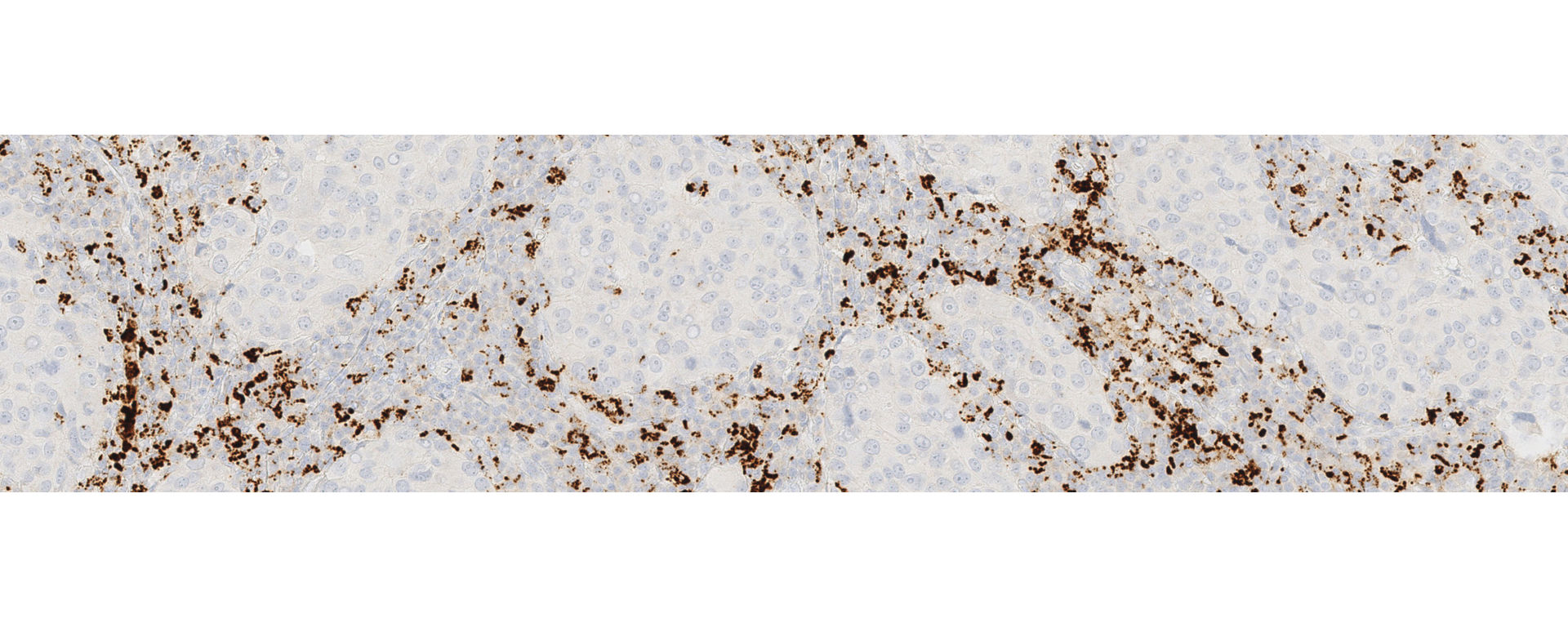 VENTANA PD-L1 SP142 IHC assay stain image