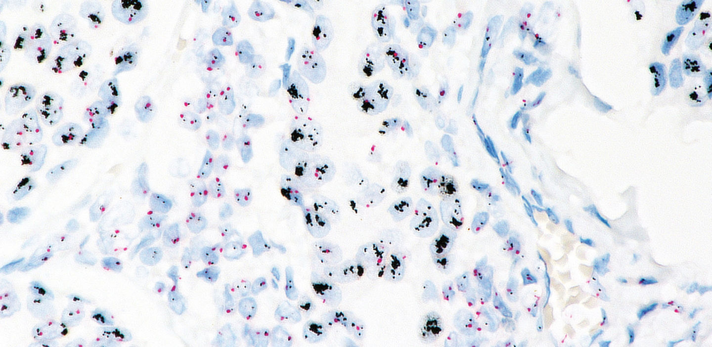 VENTANA HER2 Dual ISH DNA Probe Cocktail Assay stain image