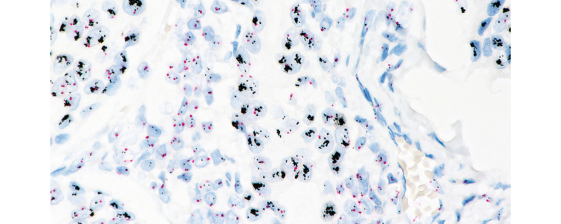 VENTANA HER2 Dual ISH DNA Probe Cocktail Assay stain image