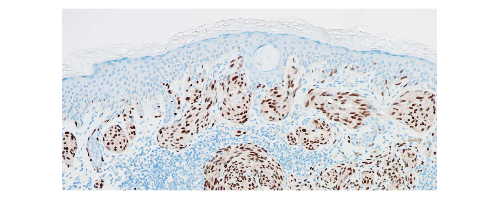 Stain - anti-PRAME (EPR20330) Rabbit Monoclonal Primary Antibody 
