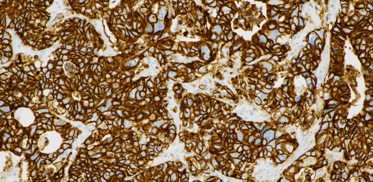 Stain image VENTANA CLDN18 (43-14A) RxDx Assay