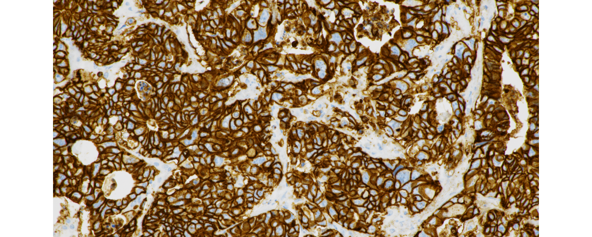 Stain image VENTANA CLDN18 (43-14A) RxDx Assay