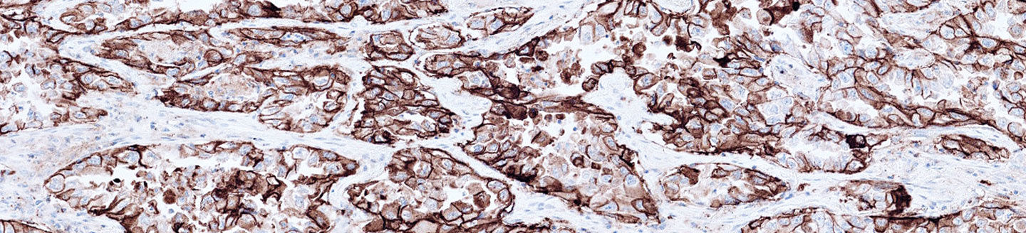 Roche’s VENTANA PD-L1 (SP263) Assay 