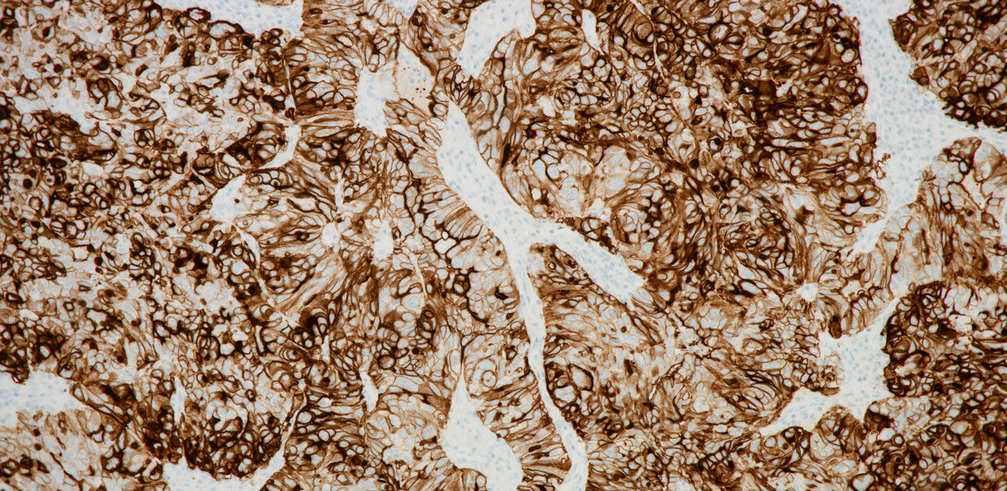 stain image VENTANA FOLR1 (FOLR-2.1) RxDx Assay