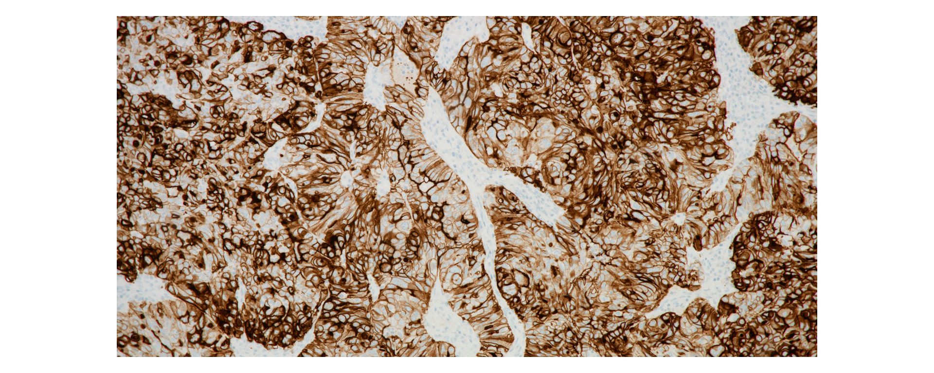 stain image VENTANA FOLR1 (FOLR-2.1) RxDx Assay