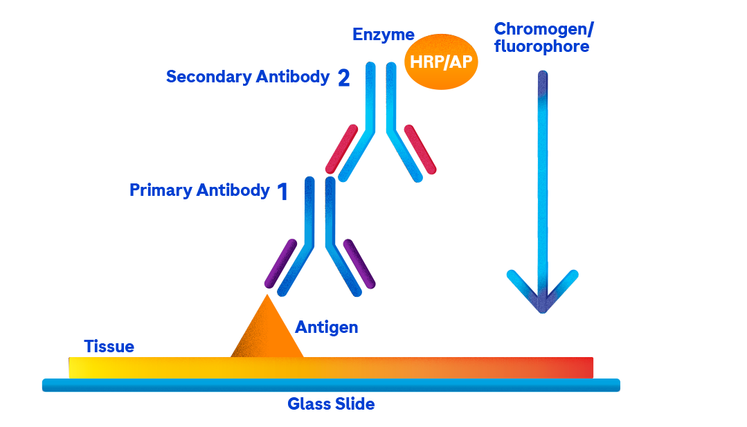 An infographic that walks though how immunohistochemistry works as a technique to detect cancer.