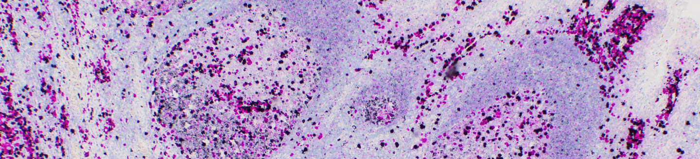  b-cells in a tonsil stained with Kappa Lambda assay