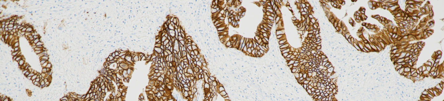 Roche receives FDA approval for first companion diagnostic to identify patients with biliary tract cancer eligible for HER2-targeted treatment with ZIIHERA